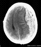 急性硬膜下血腫の頭部CT
