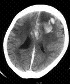 転倒事故による脳挫傷の頭部CT