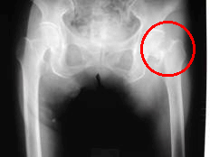 股関節の骨折1